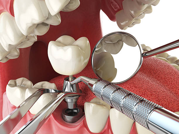 Best Knocked-Out Tooth (Avulsed Tooth) Treatment in Helotes, TX